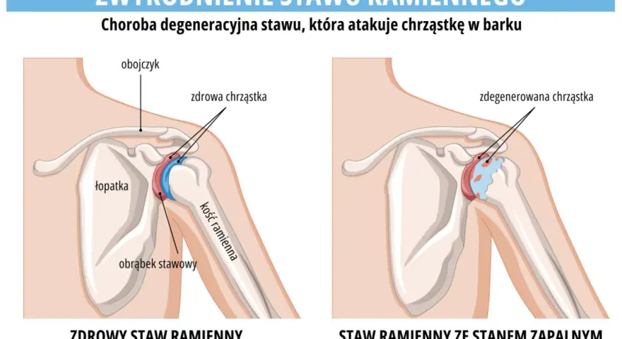 Porównanie zdrowego stawu ramiennego z tym dotkniętym chorobą zwyrodnieniową stawów, gdzie chrząstka jest zniszczona.