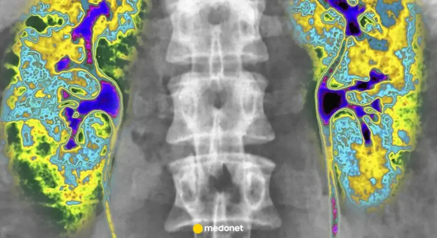 Kolorowa scyntygrafia kości pokazuje nerki i kręgosłup. Obraz uwidacznia obszary o różnej aktywności metabolicznej.