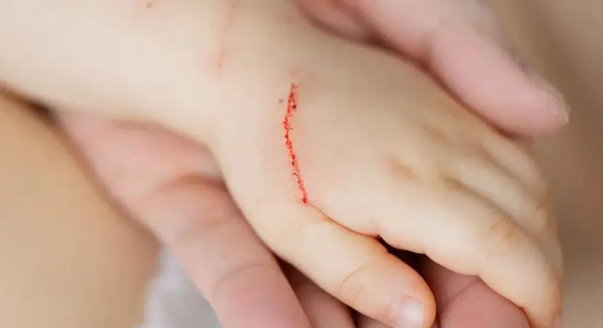 Dziecko ma zadrapanie na ręce, które może być objawem choroby kociego pazura.