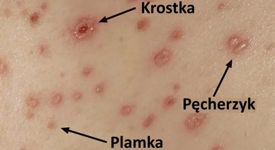 Początki ospy: czerwone plamki, krostki i pęcherzyki na skórze.