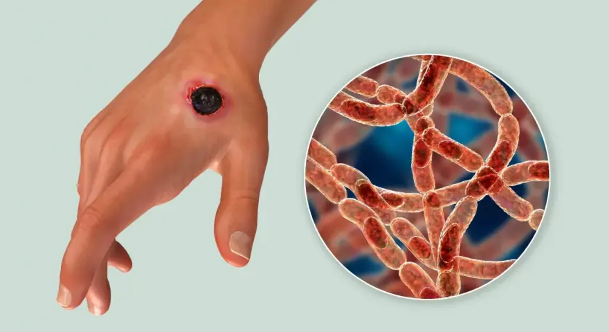 Dłoń z czarną martwiczą zmianą skórną, objawem wąglika. Obok powiększenie bakterii Bacillus anthracis.