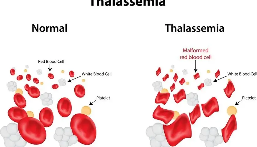 Choroby hematologiczne objawy: nie bagatelizuj tych sygnałów zdrowotnych