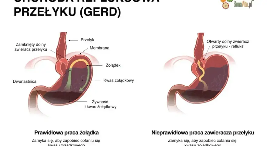 Ilustracja pokazuje prawidłowe i nieprawidłowe działanie żołądka, wyjaśniając objawy refluksu.