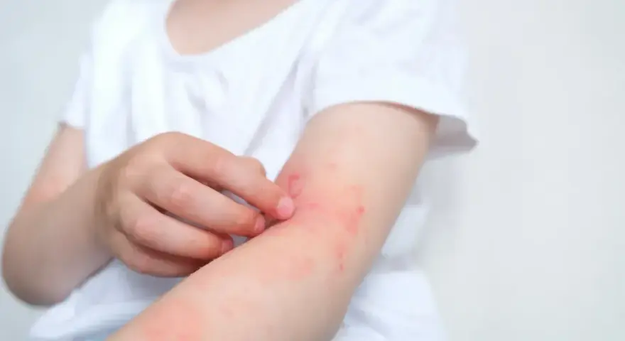 Dziecko drapie zaczerwienioną skórę na ramieniu, widoczne objawy alergii.