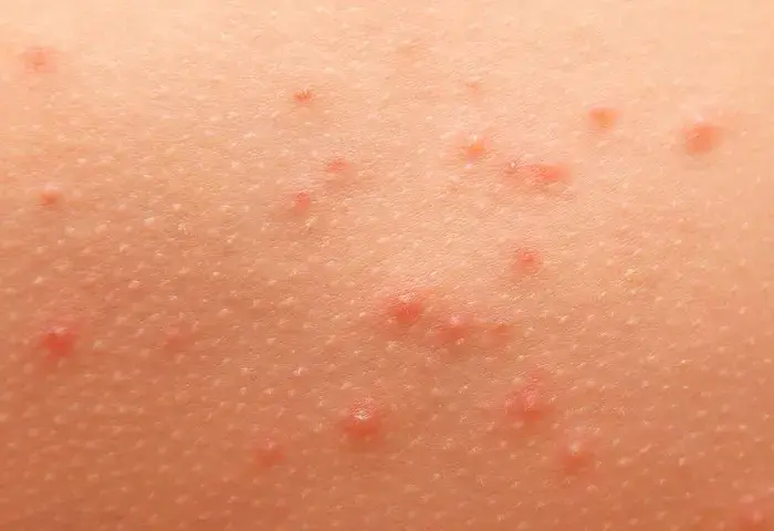 Alergia pokarmowa objawy na skórze – rozpoznaj niebezpieczne symptomy