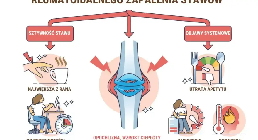 Wczesne oznaki reumatoidalnego zapalenia stawów: sztywność, opuchlizna, utrata apetytu, zmęczenie, gorączka.