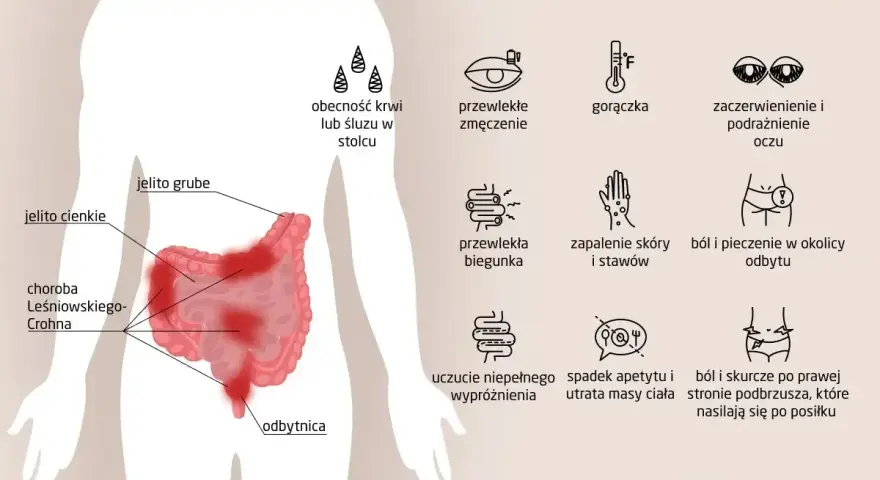Ilustracja przedstawia objawy choroby Leśniowskiego-Crohna: krew w stolcu, zmęczenie, gorączkę, podrażnienie oczu, biegunkę, bóle stawów, pieczenie odbytu, spadek apetytu i bóle brzucha.