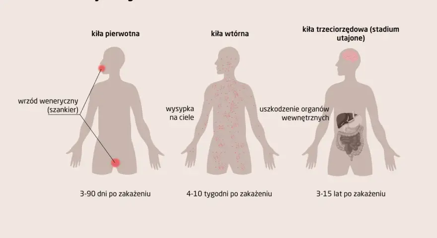 Ilustracja przedstawia stadia rozwoju kiły: pierwotne (wrzód), wtórne (wysypka) i trzeciorzędowe (uszkodzenie narządów).
