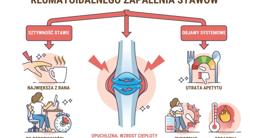Wczesne oznaki reumatoidalnego zapalenia stawów: sztywność stawu, opuchlizna, zmęczenie, gorączka, utrata apetytu.
