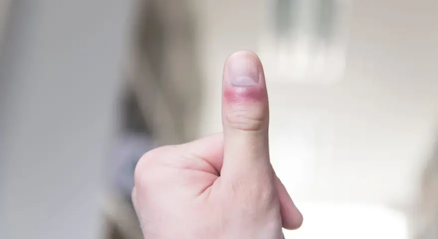 Zastrzał palca z zaczerwienieniem i obrzękiem wokół paznokcia.