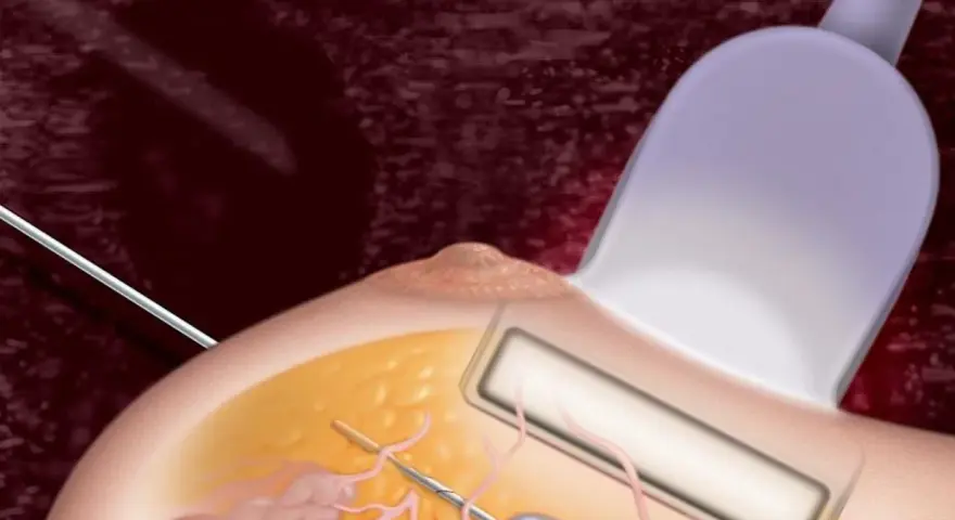 Ilustracja przedstawia biopsję mammotomiczną: igła biopsyjna pod kontrolą USG pobiera fragment tkanki piersi.