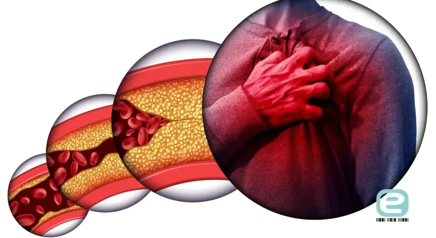Postępująca choroba wieńcowa: zwężone naczynia krwionośne z cholesterolem i czerwonymi krwinkami, obok mężczyzna trzymający się za serce.