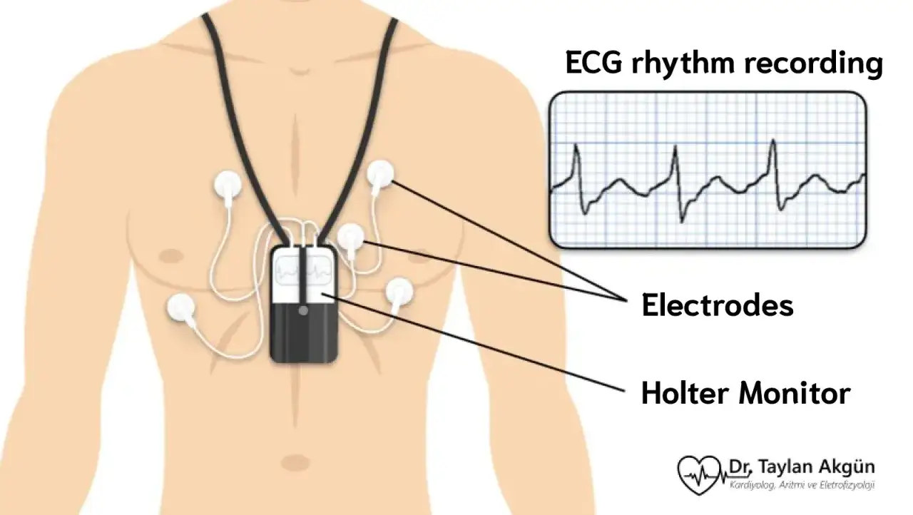 Holter ekg: urządzenie z elektrodami na klatce piersiowej, rejestrujące rytm serca.