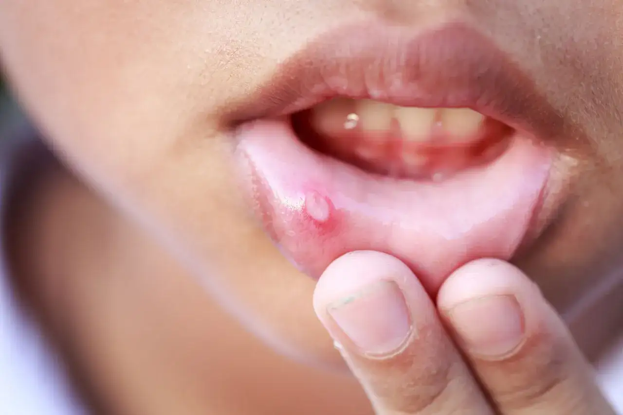 Dziecko pokazuje opryszczkowe zapalenie jamy ustnej na wardze.