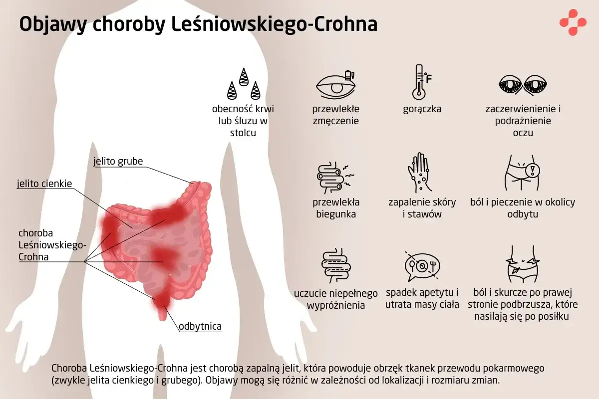Objawy choroby Leśniowskiego-Crohna: krew w stolcu, zmęczenie, gorączka, zaczerwienienie oczu, biegunka, zapalenie skóry, ból odbytu, utrata masy ciała, ból brzucha.