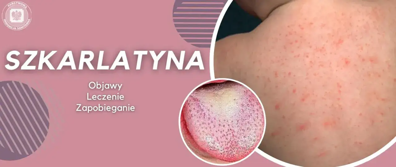 Szkarłatyna: czerwona wysypka na skórze i nalot na języku. Objawy, leczenie, zapobieganie.