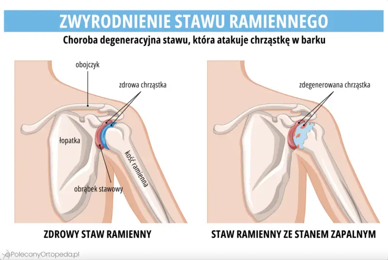 Porównanie zdrowego stawu ramiennego z tym dotkniętym chorobą zwyrodnieniową stawów, gdzie chrząstka jest zniszczona.