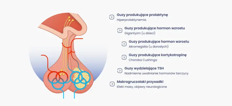 Ilustracja przysadki mózgowej z listą różnych guzów i ich objawów, np. guz przysadki mózgowej objawy.