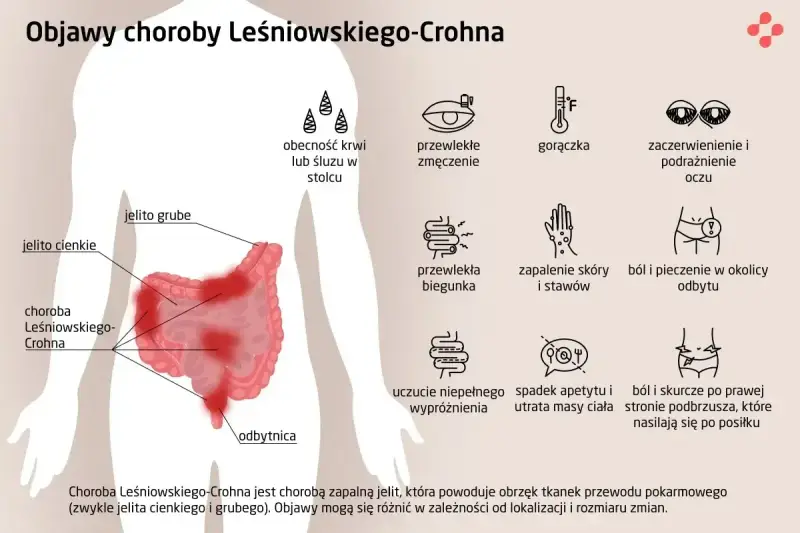 Ilustracja przedstawia objawy choroby Leśniowskiego-Crohna: krew w stolcu, zmęczenie, gorączkę, podrażnienie oczu, biegunkę, bóle stawów, pieczenie odbytu, spadek apetytu i bóle brzucha.