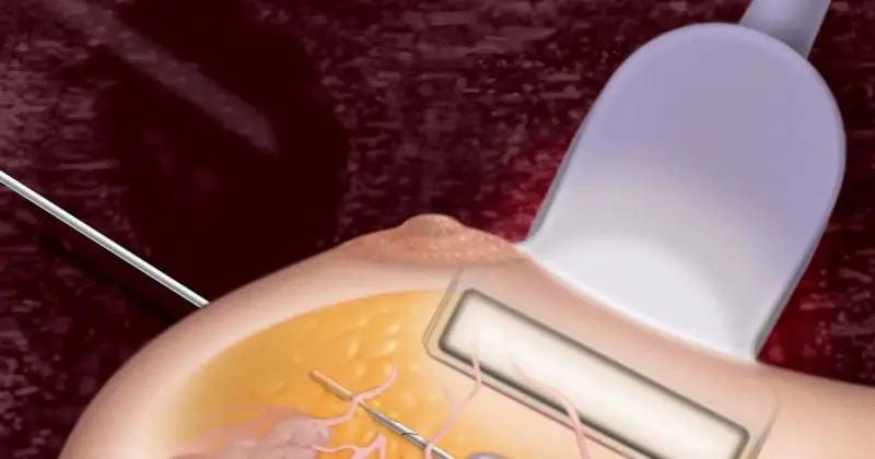 Ilustracja przedstawia biopsję mammotomiczną: igła biopsyjna pod kontrolą USG pobiera fragment tkanki piersi.